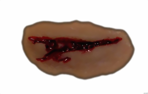 Platzwunde 1 Platzwunde 1