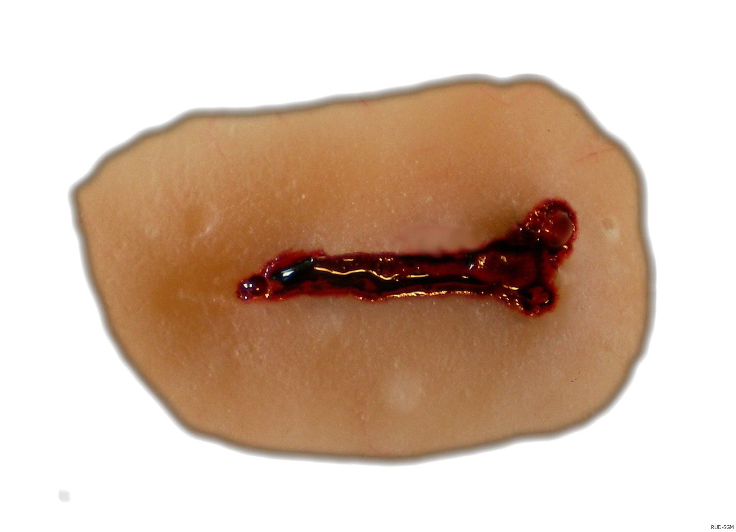 Stichwunde mit einschneidiger Klinge Stichwunde mit einschneidiger Klinge