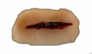 Stichwunde mit zweischneidiger Klinge Stichwunde mit zweischneidiger Klinge